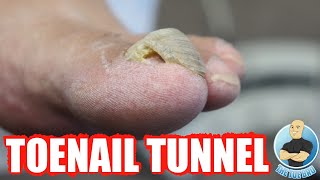 DAMAGED THICK TOENAIL HAS NOW GROWN INTO A TOENAIL TUNNEL [upl. by Goar60]