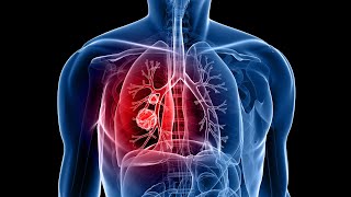 Adenocarcinoma transformation to small cell lung cancer with C797S acquire resistance to osimertinib [upl. by Ardine]