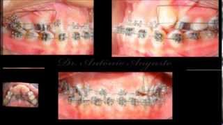 Orthodontic Treatment  Class III  Time Lapse [upl. by Amsab]