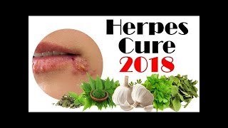 Latest Herpes Cure 2018  Cure Herpes With Ayurveda [upl. by Nodnyl685]