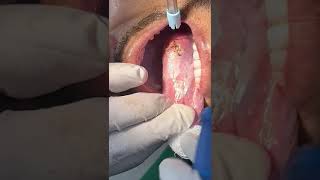 LEUKOPLAKIA REMOVAL [upl. by Beckerman]