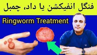 Fungal Infection  Ringworm  Kharish Homeopathic Medicines [upl. by Irahs36]