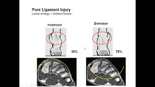 Imaging of Lisfranc Injury [upl. by Ylrebmyk]