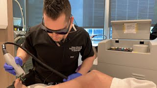 Vbeam Laser  Telangiectasia Spider Angioma  West Hollywood CA  Dr Jason Emer [upl. by Mehalick96]