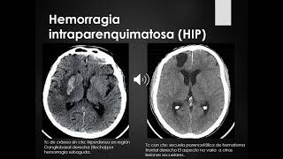 Teórico de imágenes 6 Trastornos hemodinámicos [upl. by Aneleve]