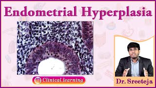 48 Endometrial Hyperplasia [upl. by Sedicla653]