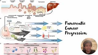 Pancreatic Cancer Progression Code 322 [upl. by Yeaton]