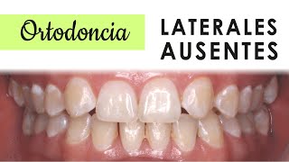 AGENESIA DENTAL  TRATAMIENTOS LATERALES SUPERIORES AUSENTES [upl. by Osbert]