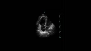 Signo de McConnell Embolia pulmonar aguda [upl. by Eivi47]