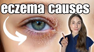 Causes And Treatment Of Eyelid Eczema Explained [upl. by Tiduj]