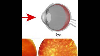 Birdshot Chorioretinopathy Symptoms and Causes  Diagnosis  Treatment  Prevention health [upl. by Suiluj]