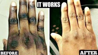 HOW TO GET RID OF DARK KNUCKLES NATURALLY IN 3 DAYS  It Really Works [upl. by Oslec720]