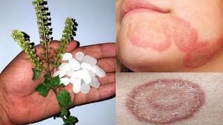 दाद खाज खुजली दिनाय कि सिर्फ़ 2 दिनों में जड़ से छुट्टी कर देगा ये नुस्खा  ringworm treatment home [upl. by Tisbee509]