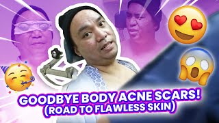 GOODBYE BODY ACNE SCARS ROAD TO FLAWLESS SKIN  CHAD KINIS VLOGS [upl. by Lindahl]