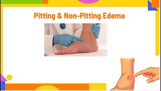 pitting amp nonpitting edema  edema types and causes  edema  PhysiotherapyKnowledge [upl. by Adnana]