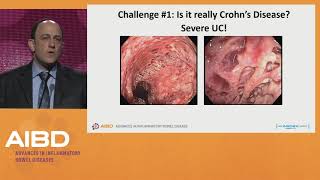 Challenges in the treatment of severe Crohns disease [upl. by Norvol]