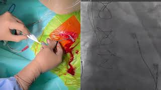 Left bundle branch area pacing with lumenless lead 3830 [upl. by Araiet]