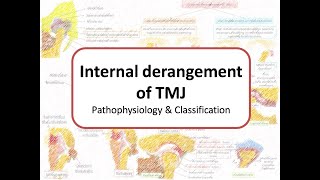 Internal Derangement of TMJ Disc displacement withwithout reduction amp Wilkes classification [upl. by Nytsuj]