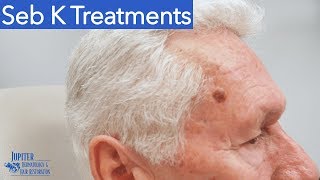 Seborrheic Keratosis Treatment amp Removal Liquid Nitrogen amp Curetagge [upl. by Minetta]