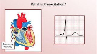 Advanced EKGs  WolffParkinsonWhite WPW Syndrome [upl. by Enoryt]