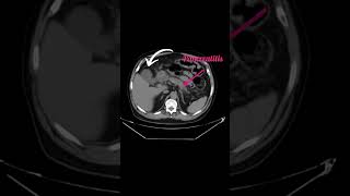 Acute calculus cholecystitis [upl. by Ward]