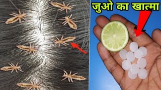 सर की जुएं lice 1 बार के इस्तेमाल से ख़तम  बालों के लिए  Lice Removal at Home  Hair Growth Tips [upl. by Eicam]