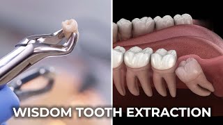 Wisdom Tooth Extraction  عقل داڈ نکالنا  The Complete Guide to Wisdom Tooth Extraction [upl. by Salas264]