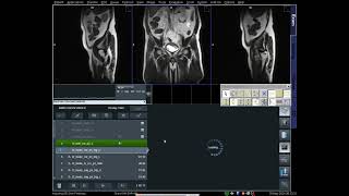 How to MRI of Whole Abdomen Planning  Abdomen  MRI [upl. by Nwavahs809]