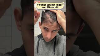 How to use derma roller for hair growth treatment [upl. by Hearsh]