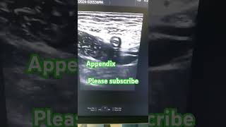 Appendix ultrasound video ultrasound doctor appendix ultrasoundscans [upl. by Tammara308]