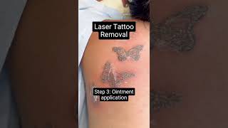 Laser Tattoo Removal [upl. by Heyra]