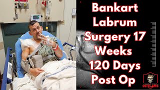 Bankart Labrum Surgery 17 weeks 120 days Post Op [upl. by Milissent]