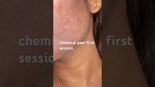 chemical peel first session shortviral shortvideo chemical peeling [upl. by Odlaw]