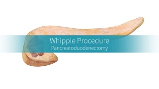 Whipple Procedure Why and How the Surgery Is Performed [upl. by Wardieu]