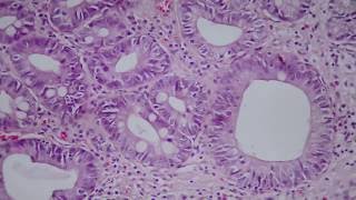 013 Intestinal metaplasia and low grade dysplasia in gastric biopsy [upl. by Rowan]