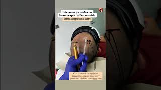 Mesoterapia Capilar Mesoterapia con Dutasteride para alopecia mesoterapia hair cabello salud [upl. by Nive]