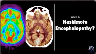 Hashimoto Encephalopathy Is Your Brain at Risk [upl. by Hplar1]