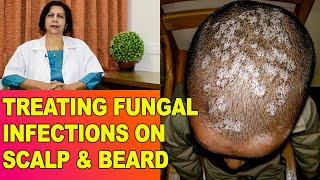 FungalFangal Infections Itching in HeadScalp amp Beard  Treatment  Dr Vijaylaxmi Singh [upl. by Kissner]