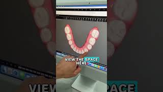 Invisalign to close spaces and gaps [upl. by Arvind515]