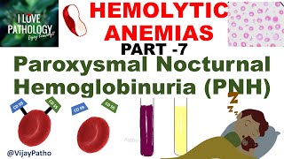 Hemolytic Anemias Part 7 Paroxysmal nocturnal hemoglobinuria PNH [upl. by Cram454]