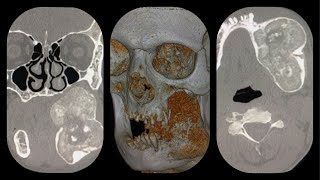 mandibular fibrous dysplasia CT scan and 3D reconstruction [upl. by Anawal]