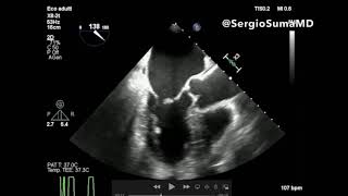 MITRAL REGURGITATION TRANSESOPHAGEAL ECHOCARDIOGRAPHY TEE  CASE 4 [upl. by Ahsenrad]