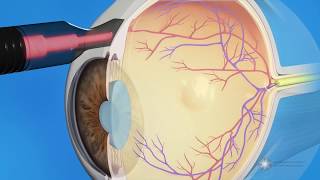 CPC for Glaucoma Treatment [upl. by Fidelity362]