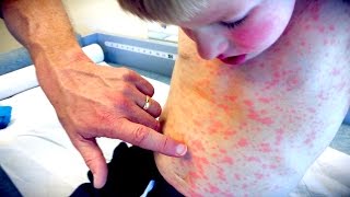 IMPRESSIVE FULL BODY RASH  Live Diagnosis With Dr Paul [upl. by Amathist]