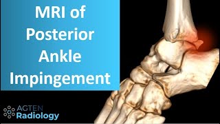 Posterior ankle impingement on MRI [upl. by Neelhtakyram]