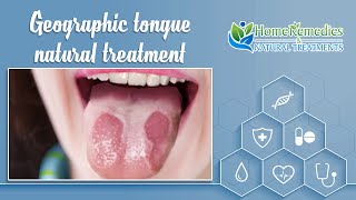 Home remedies and natural treatments for geographic tongue [upl. by Eelnyl]