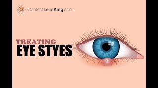 How to Treat Eye Styes [upl. by Kristofer]