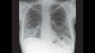 Deciphering a Mysterious Lung Lesion Radiology Case Analysisquot [upl. by Atekahs]