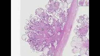 Histopathology OvarySerous cystadenoma [upl. by Oetomit]