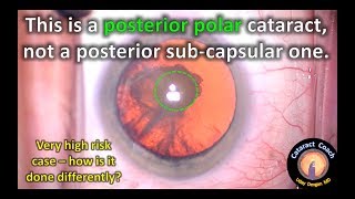 Posterior Polar Cataract Surgery  keys to success [upl. by Attennyl254]